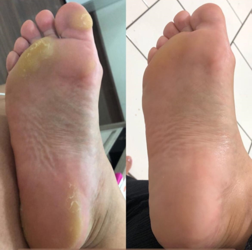 Imagem do serviço: Calosidade Hiper Queratose 